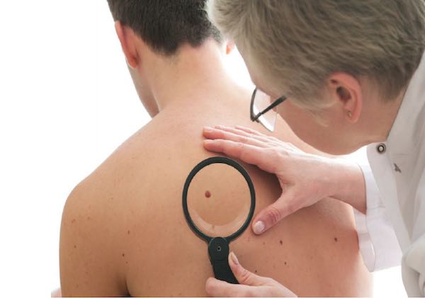 A Palazzo della Corgna, screening dermatologico gratuito per il controllo dei nei